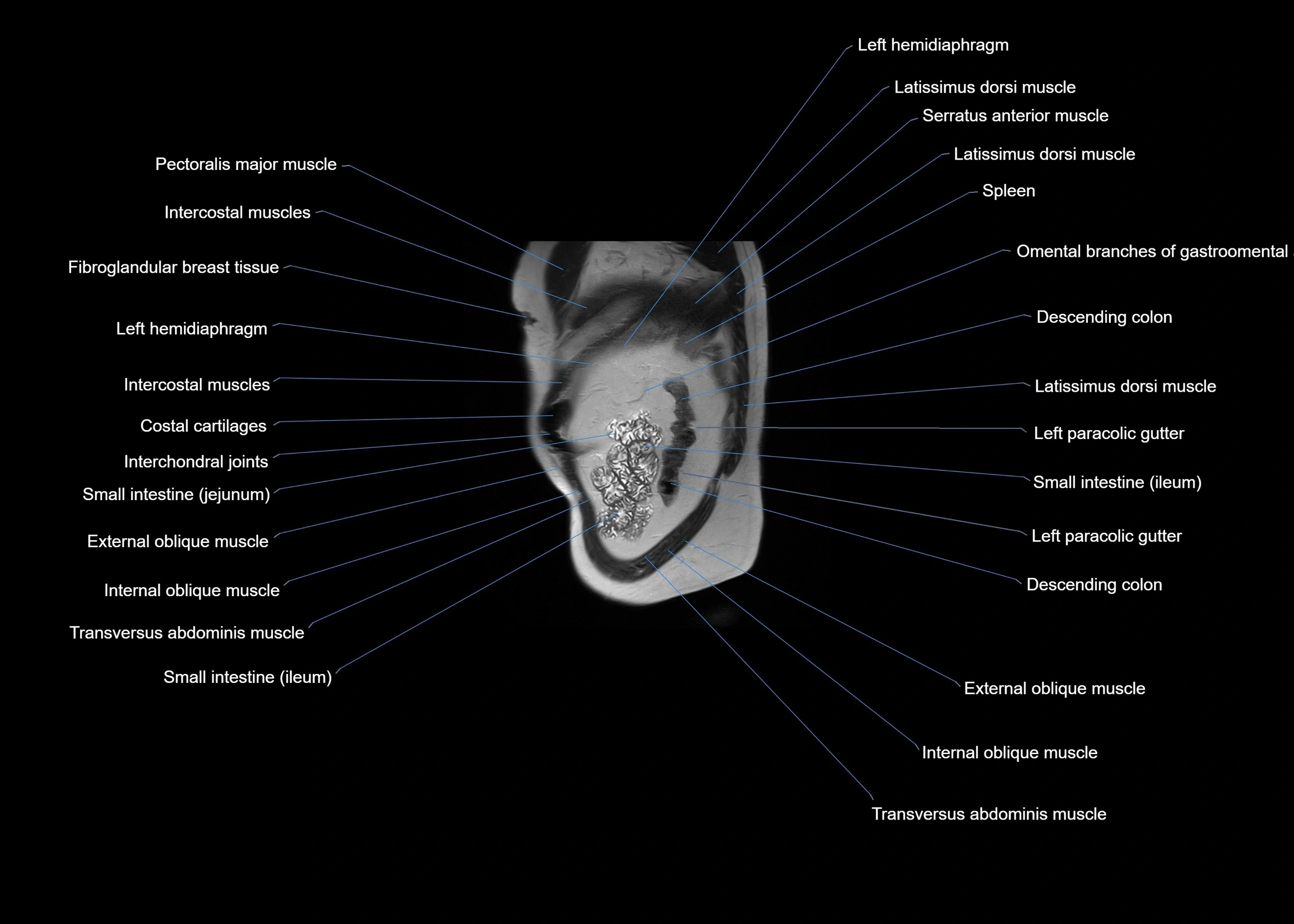 MRI abdomen sagittal cross sectional anatomy  radiology  image-img-00001-00062.webp